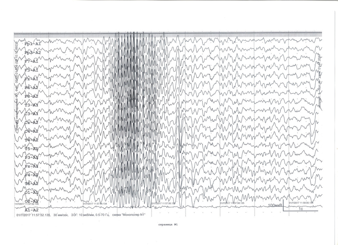 Эпи ээг. Рисунок нормальных показателей ЭЭГ. Нормальная диаграмма ЭЭГ. Патологическая ЭЭГ. Нормы ЭЭГ эпиактивность.