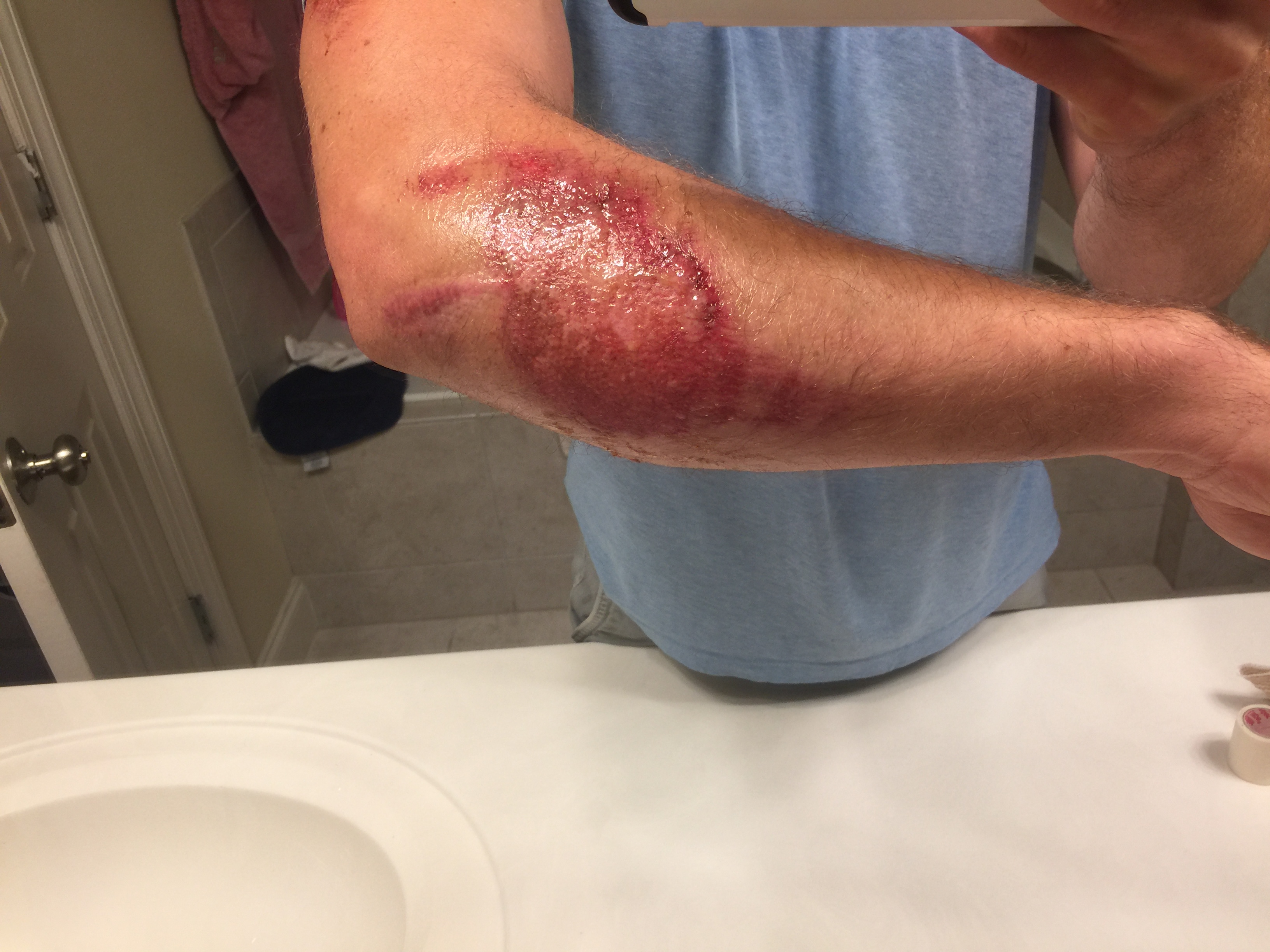 tell if road rash is infected